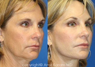 Fat Transfer Before & After Gallery - Patient 71701381 - Image 1