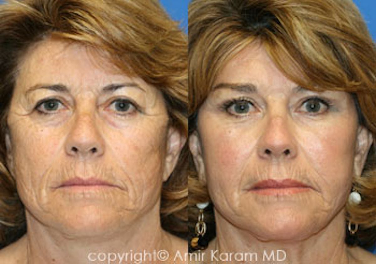 Fat Transfer Before & After Gallery - Patient 71701382 - Image 1