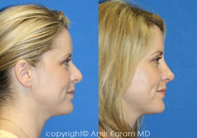 Rhinoplasty Before & After Gallery - Patient 71701385 - Image 1