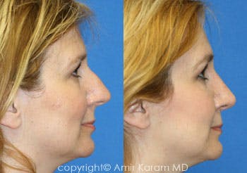 Rhinoplasty Before & After Gallery - Patient 71701388 - Image 1