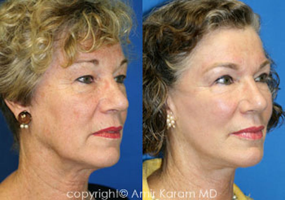 Fat Transfer Before & After Gallery - Patient 71701389 - Image 1