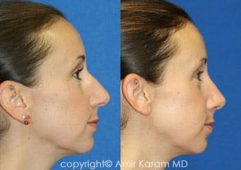 Rhinoplasty Before & After Gallery - Patient 71701391 - Image 1