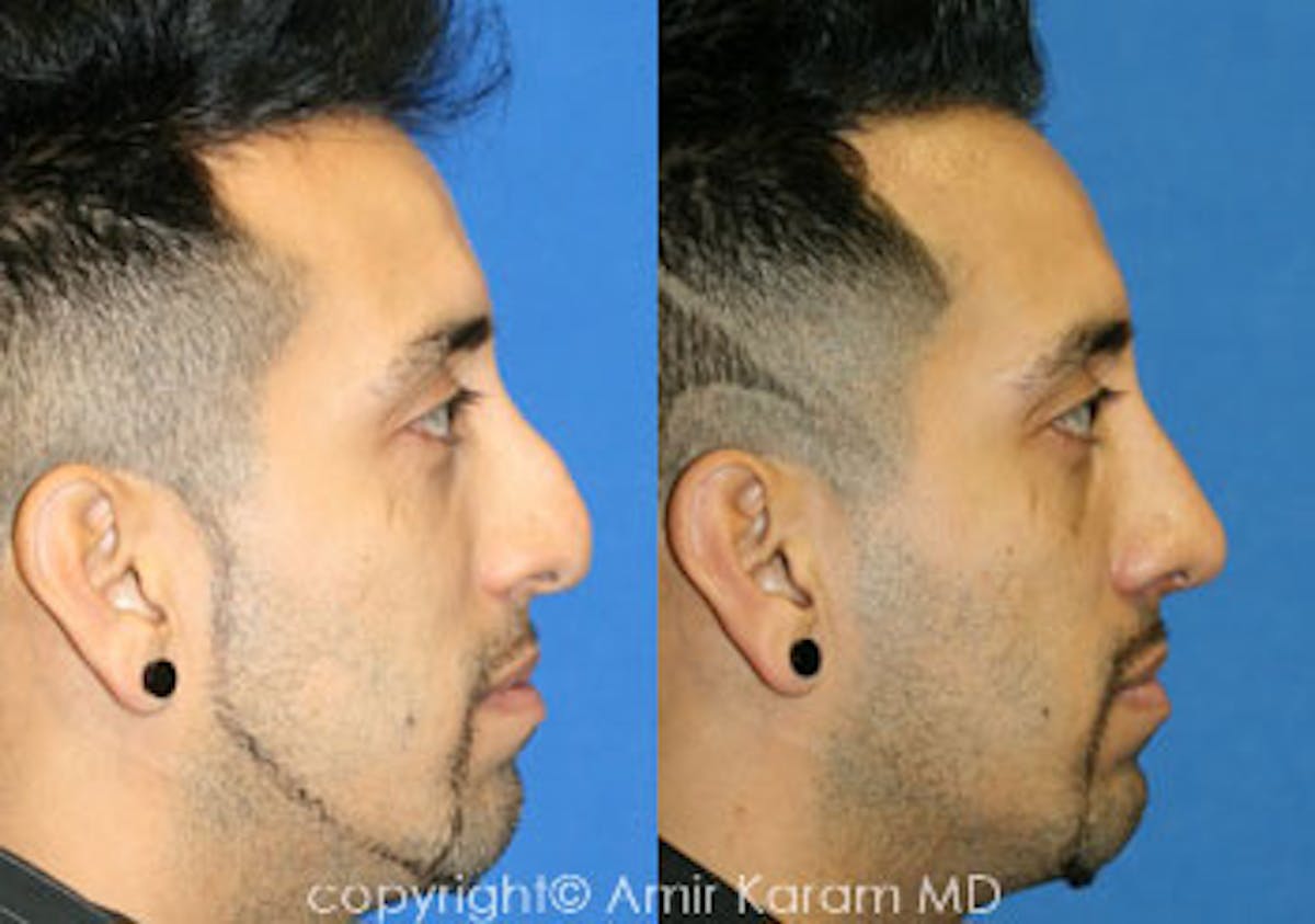 Rhinoplasty Before & After Gallery - Patient 71701394 - Image 1