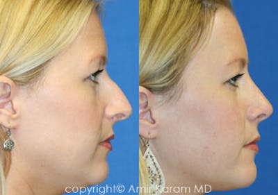 Rhinoplasty Before & After Gallery - Patient 71701396 - Image 1