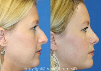 Rhinoplasty Before & After Gallery - Patient 71701396 - Image 1