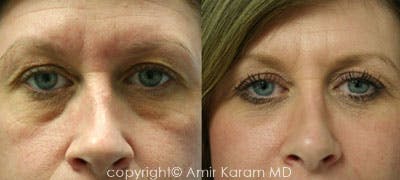 Fat Transfer Before & After Gallery - Patient 71701399 - Image 1