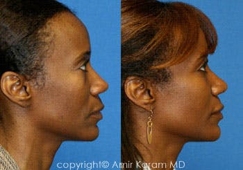 Fat Transfer Before & After Gallery - Patient 71701403 - Image 1