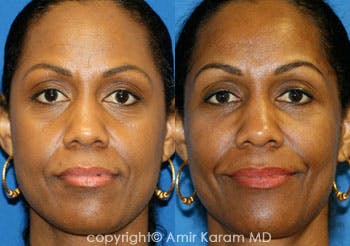 Fat Transfer Before & After Gallery - Patient 71701406 - Image 1