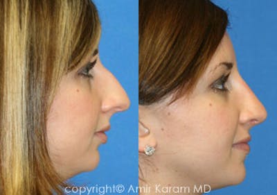 Rhinoplasty Before & After Gallery - Patient 71701405 - Image 1