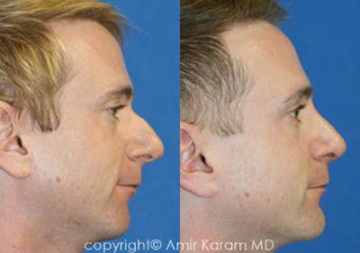 Rhinoplasty Before & After Gallery - Patient 71701413 - Image 1