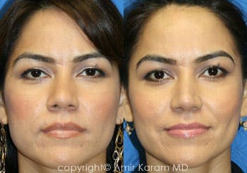Rhinoplasty Before & After Gallery - Patient 71701420 - Image 1