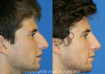 Rhinoplasty Before & After Gallery - Patient 71701424 - Image 1