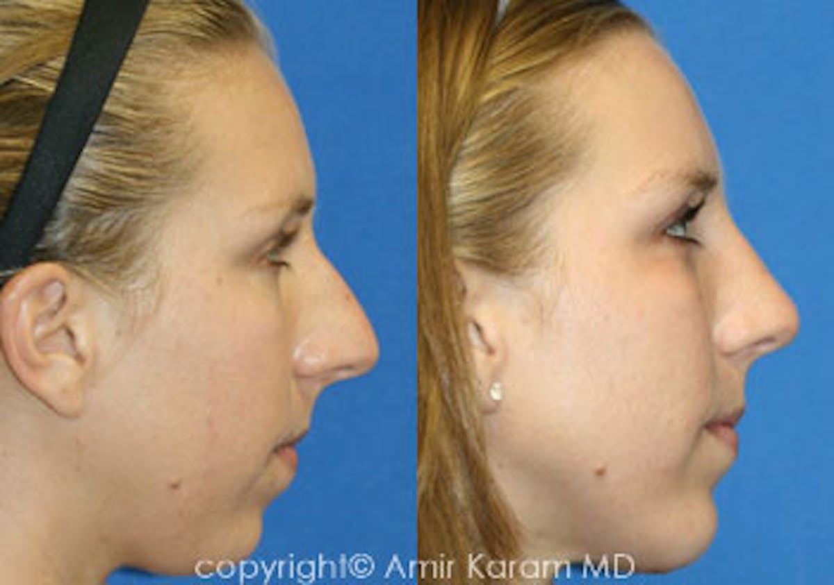 Rhinoplasty Before & After Gallery - Patient 71701426 - Image 1