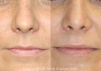 Rhinoplasty Before & After Gallery - Patient 71701427 - Image 1