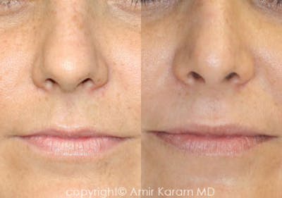 Rhinoplasty Before & After Gallery - Patient 71701427 - Image 1