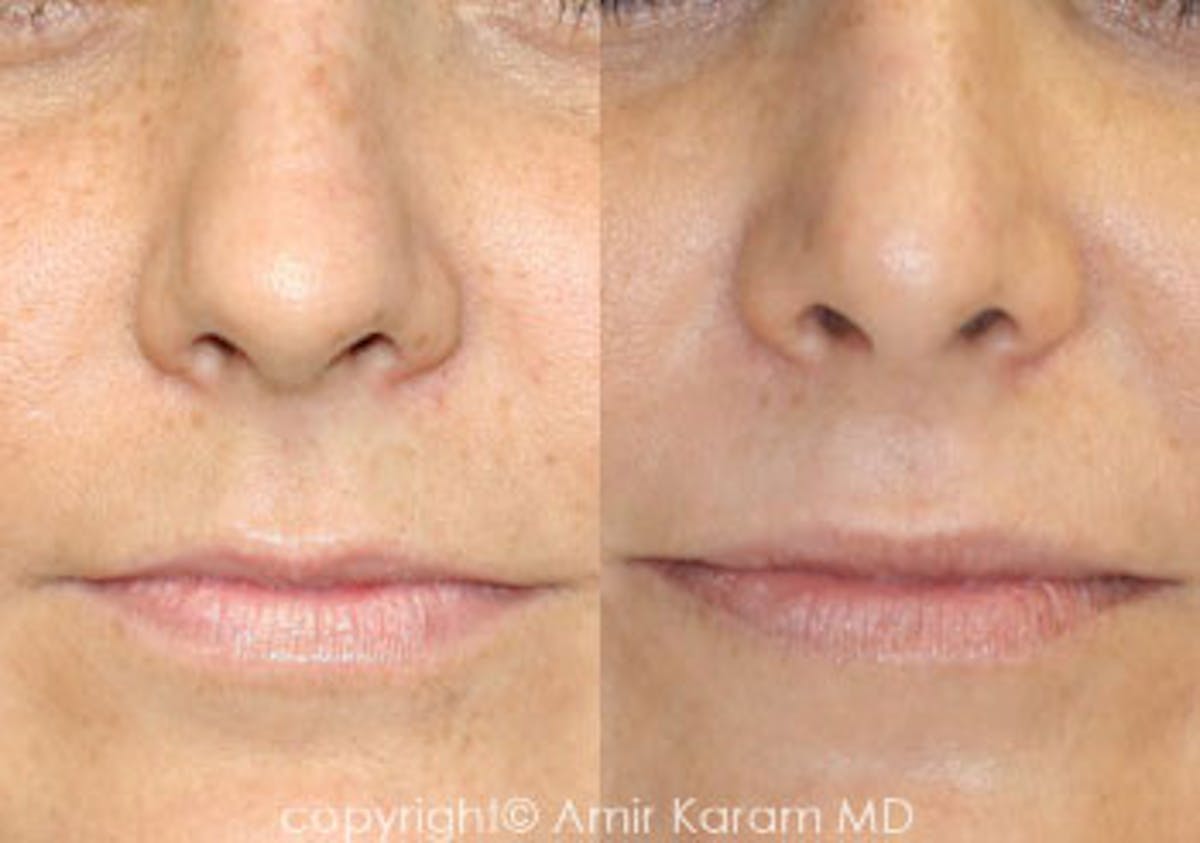 Rhinoplasty Before & After Gallery - Patient 71701427 - Image 1