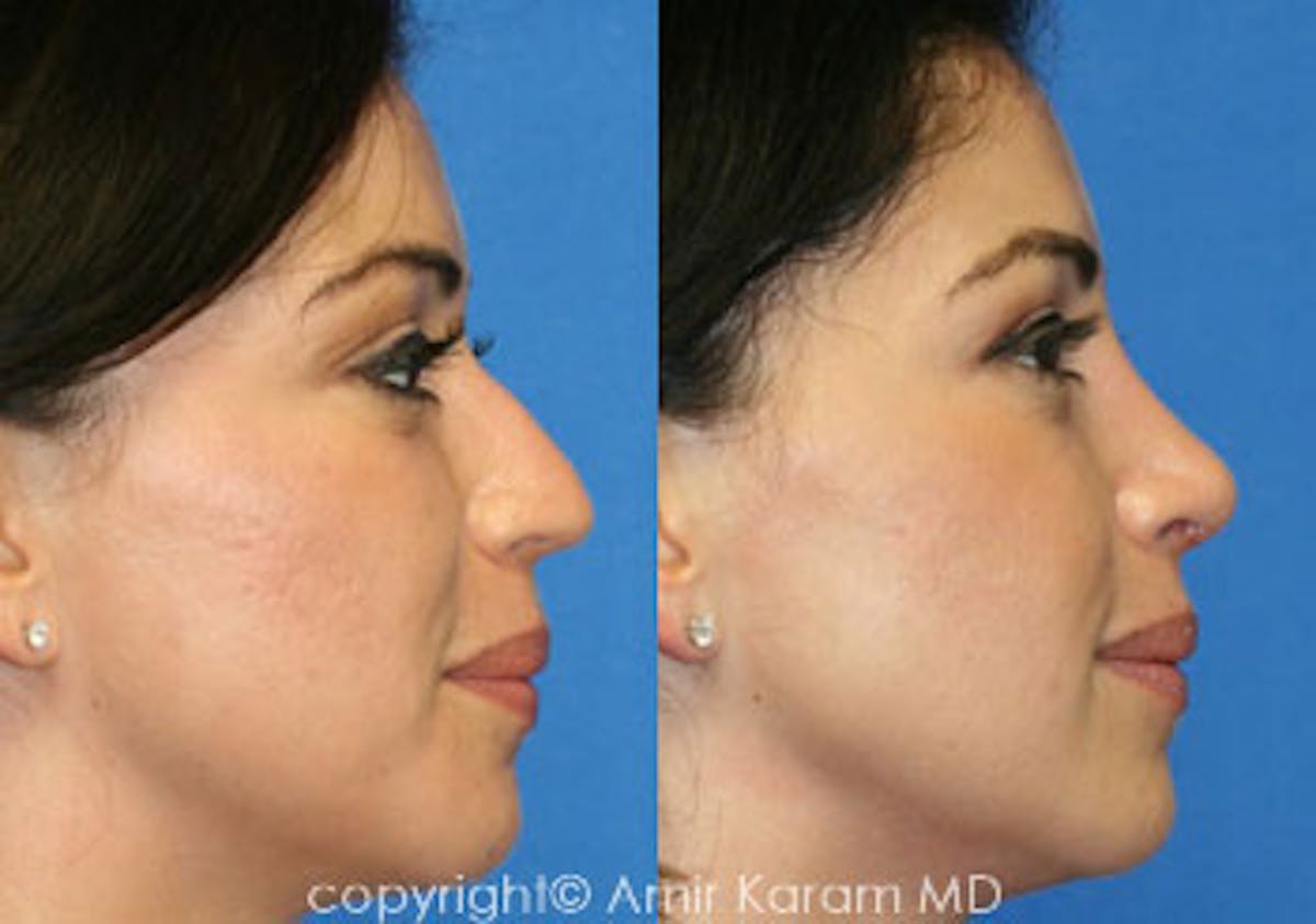 Rhinoplasty Before & After Gallery - Patient 71701433 - Image 1