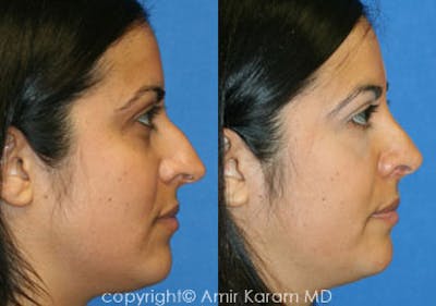 Rhinoplasty Before & After Gallery - Patient 71701435 - Image 1