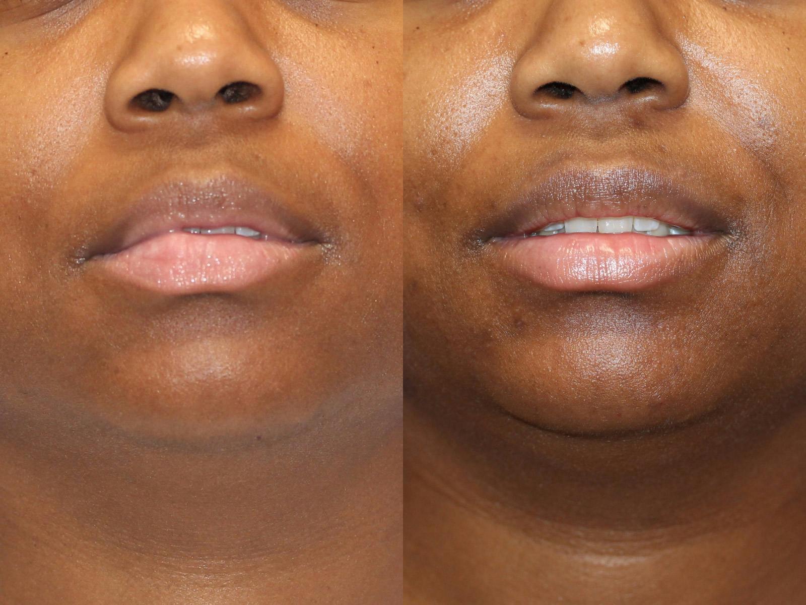 Lip Reduction