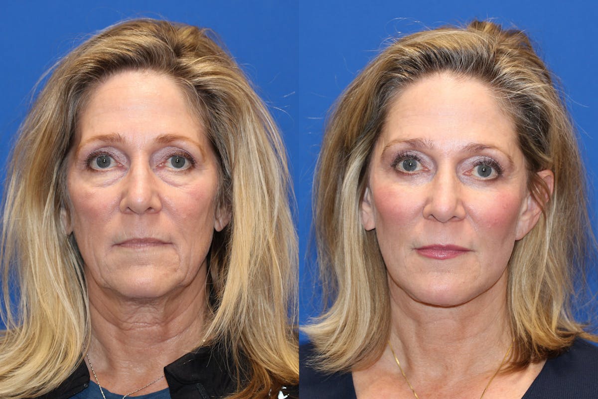 Neck Lift Before & After Gallery - Patient 71701606 - Image 3