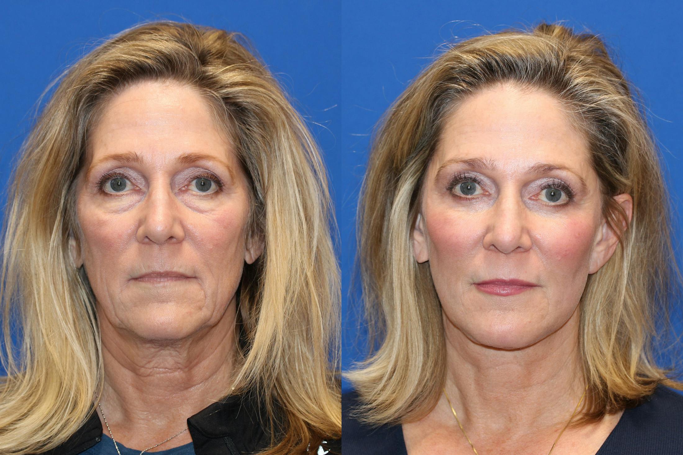 Neck Lift Before & After Gallery - Patient 71701606 - Image 3