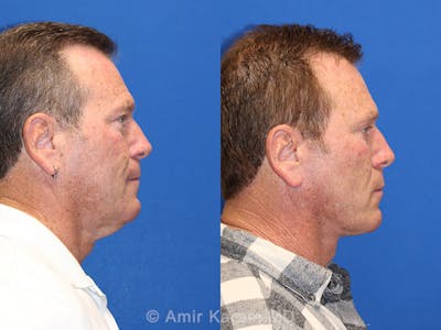 Neck Lift Before & After Gallery - Patient 71701610 - Image 1
