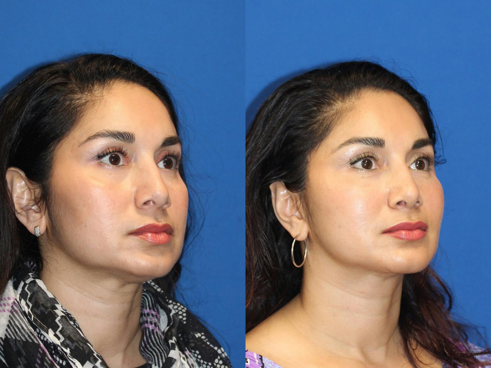 Neck Lift Before & After Gallery - Patient 71701613 - Image 1