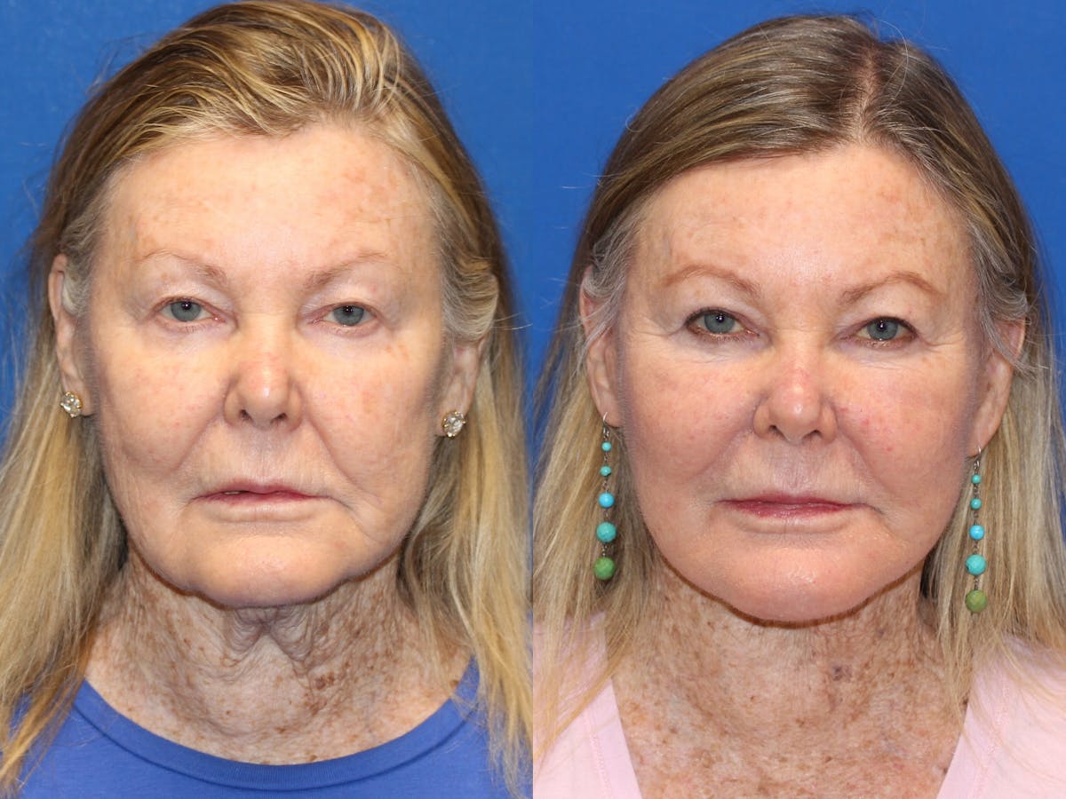 Neck Lift Before & After Gallery - Patient 71701616 - Image 3