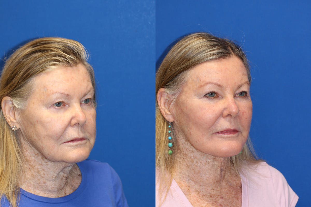 Neck Lift Before & After Gallery - Patient 71701616 - Image 2