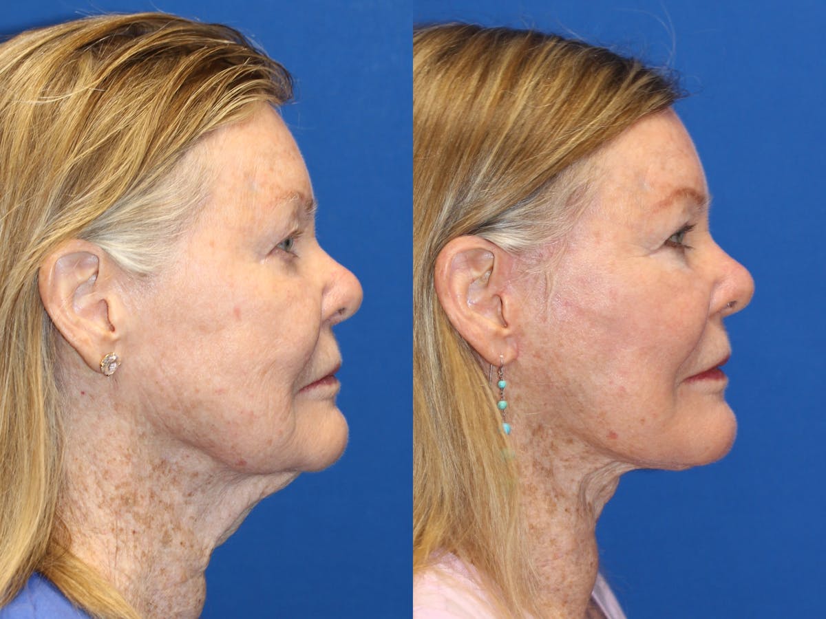 Neck Lift Before & After Gallery - Patient 71701616 - Image 1