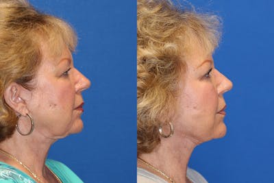 Neck Lift Before & After Gallery - Patient 71701623 - Image 1