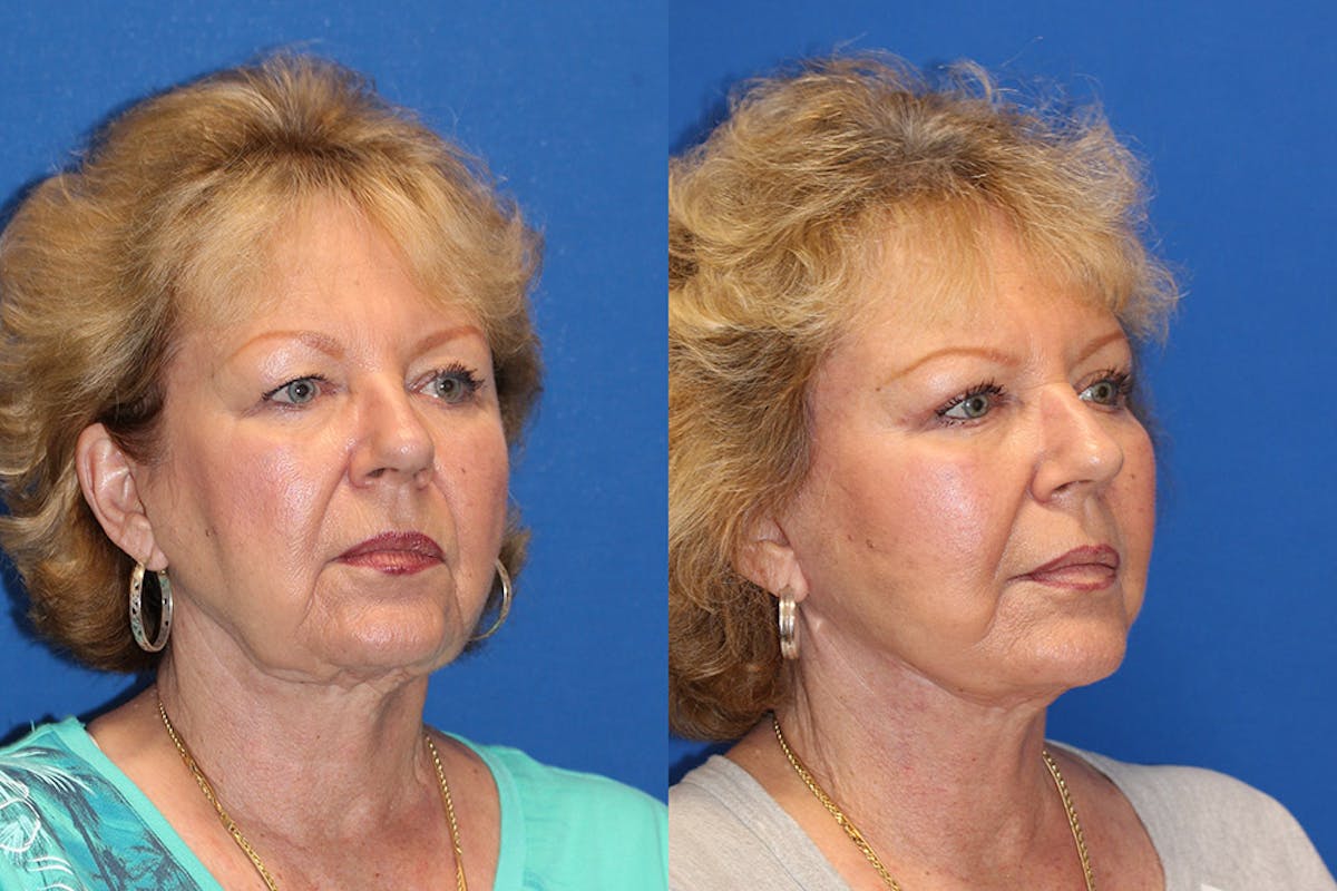 Neck Lift Before & After Gallery - Patient 71701623 - Image 2