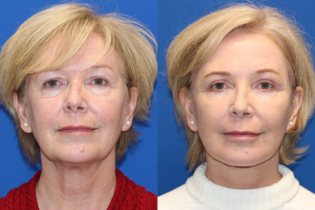Neck Lift Before & After Gallery - Patient 71701630 - Image 2