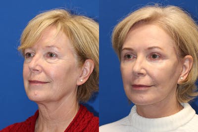 Neck Lift Before & After Gallery - Patient 71701630 - Image 1