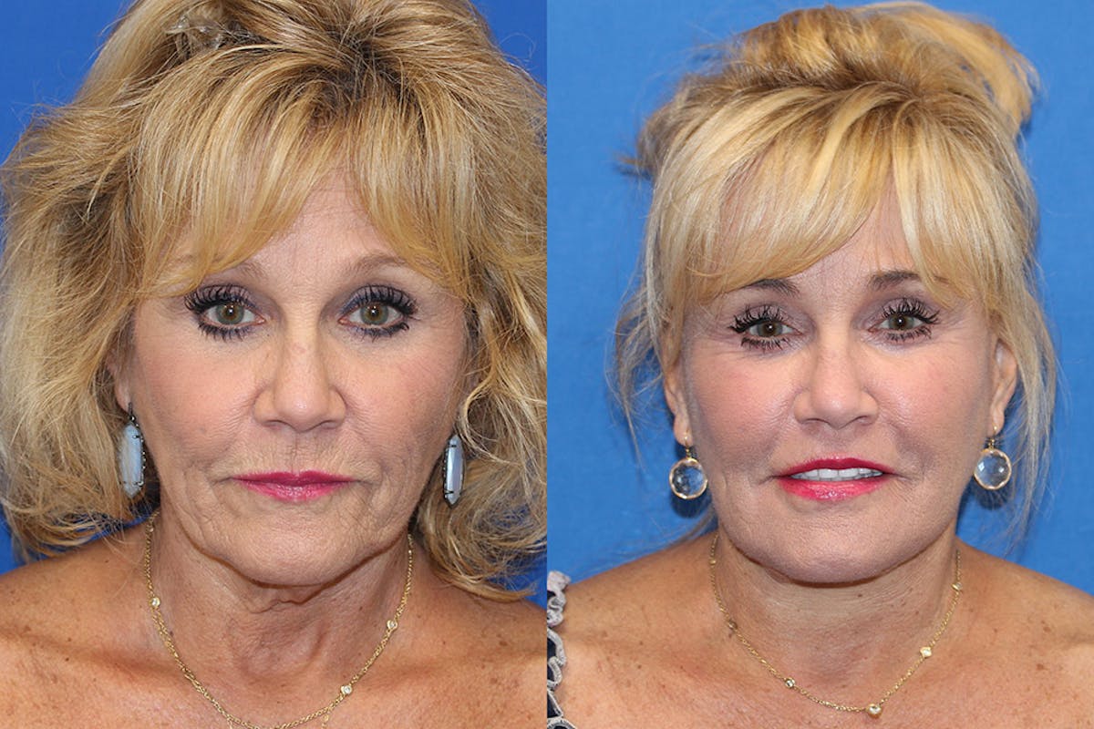 Neck Lift Before & After Gallery - Patient 71701631 - Image 2