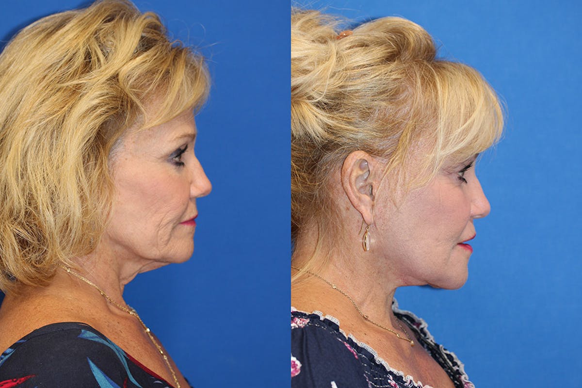 Neck Lift Before & After Gallery - Patient 71701631 - Image 1