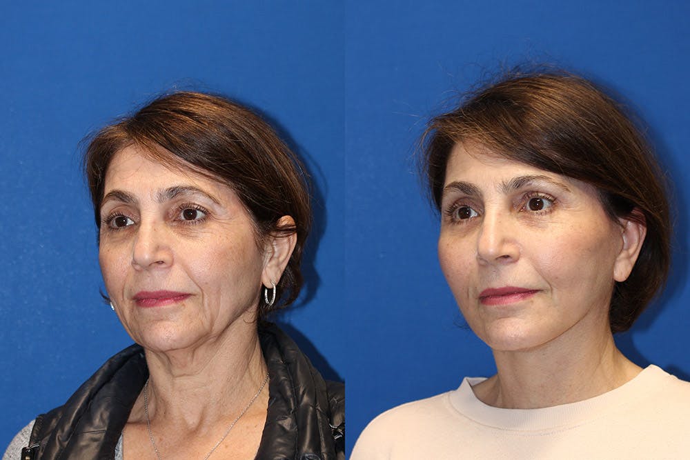 Neck Lift Before & After Gallery - Patient 71701779 - Image 2