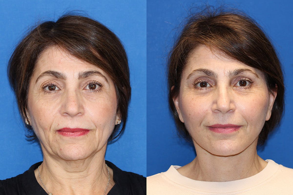 Neck Lift Before & After Gallery - Patient 71701779 - Image 3