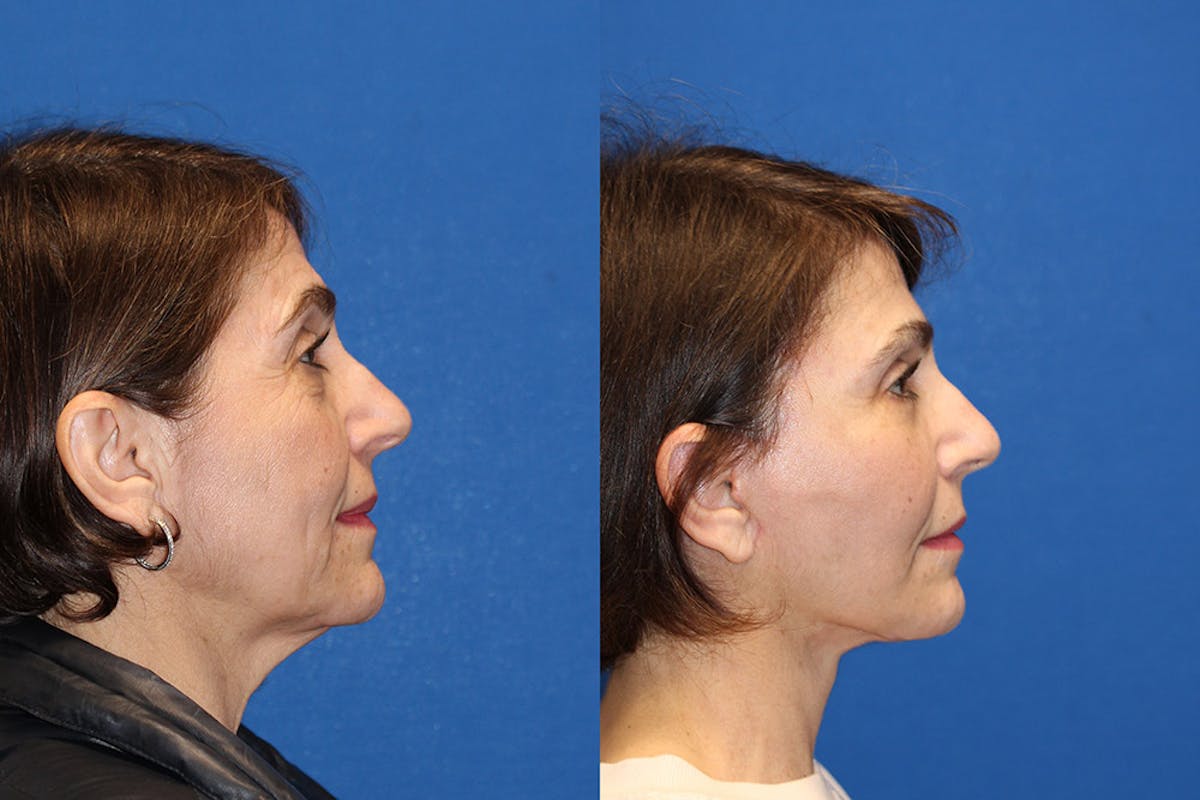 Neck Lift Before & After Gallery - Patient 71701779 - Image 1