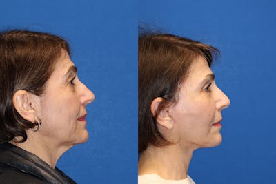 Neck Lift Before & After Gallery - Patient 71701779 - Image 1