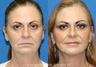 Chemical Peels Before & After Gallery - Patient 71701635 - Image 1