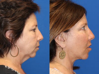 Neck Lift Before & After Gallery - Patient 71701788 - Image 1