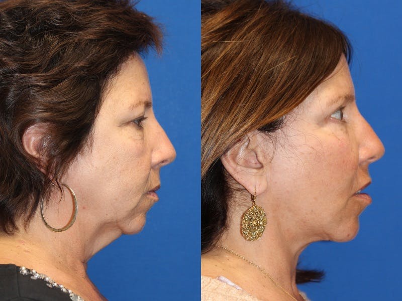Neck Lift Before & After Gallery - Patient 71701788 - Image 1