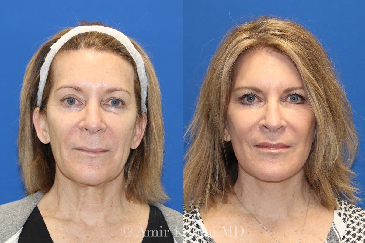 Laser Before & After Gallery - Patient 71701787 - Image 1