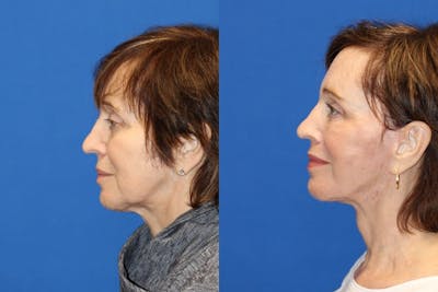 Neck Lift Before & After Gallery - Patient 71701793 - Image 1