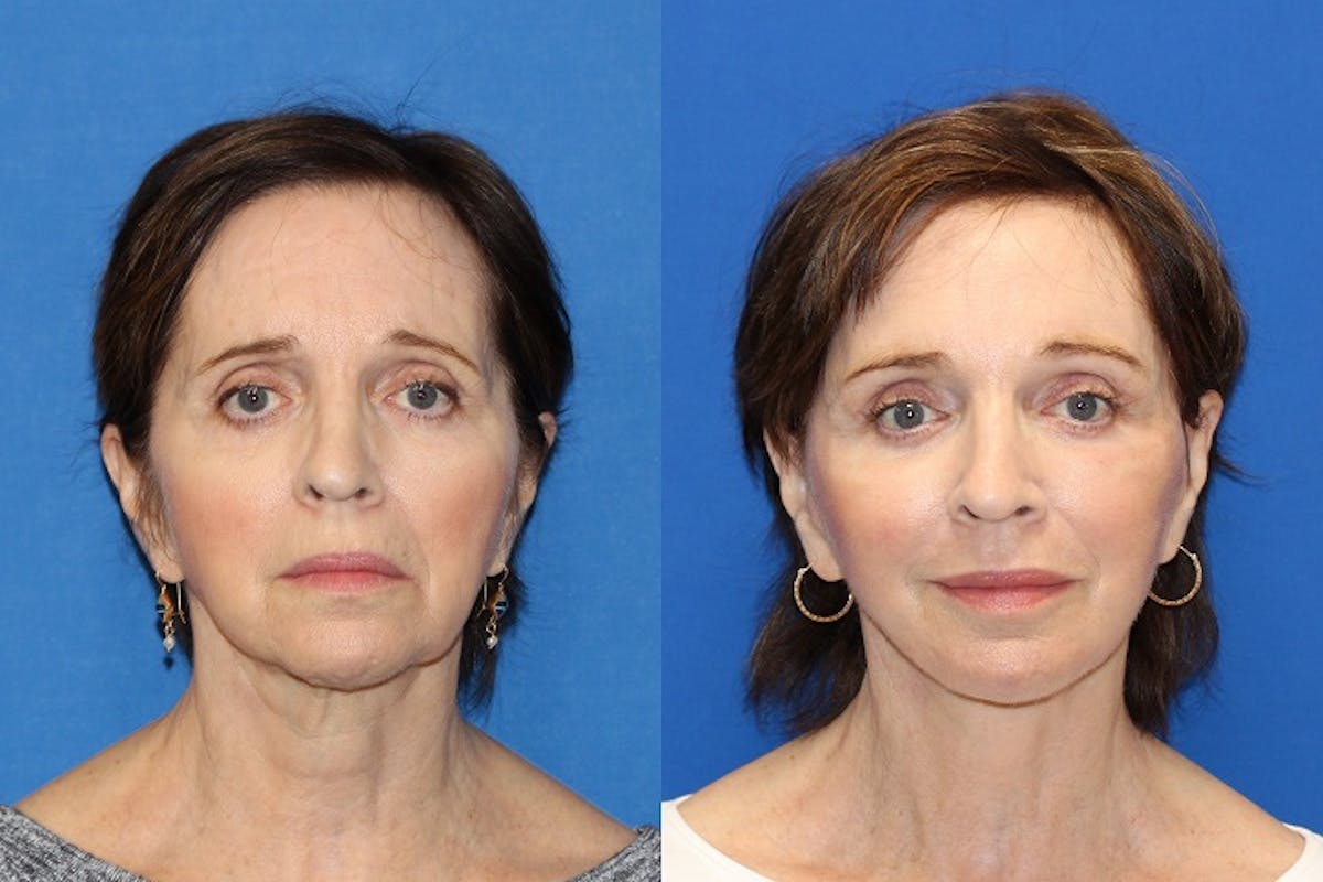 Neck Lift Before & After Gallery - Patient 71701793 - Image 4