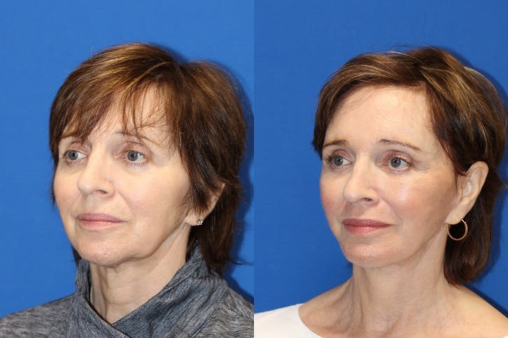 Neck Lift Before & After Gallery - Patient 71701793 - Image 3