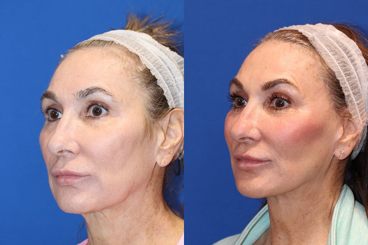 Neck Lift Before & After Gallery - Patient 71701795 - Image 2