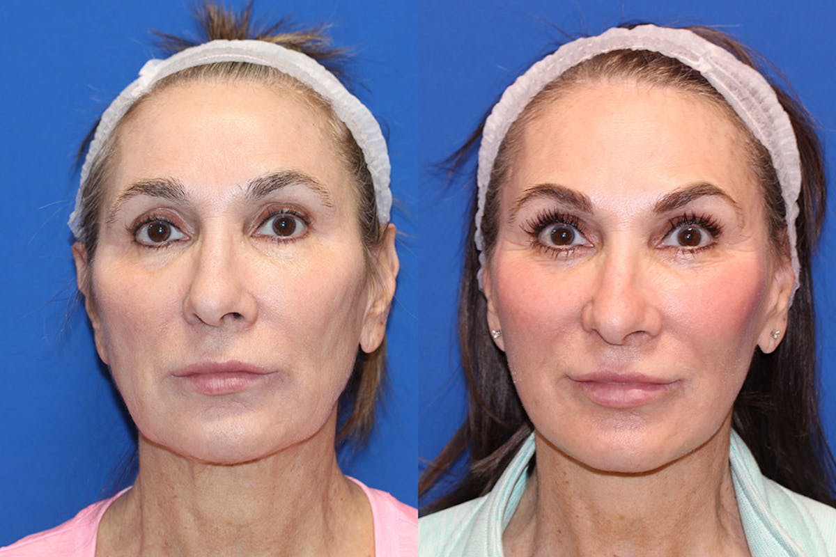 Neck Lift Before & After Gallery - Patient 71701795 - Image 3
