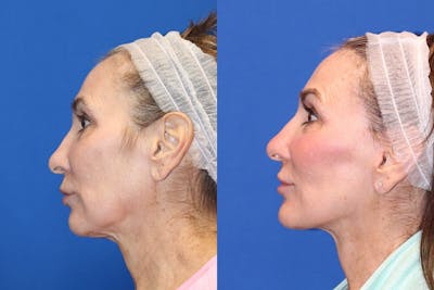 Neck Lift Before & After Gallery - Patient 71701795 - Image 1